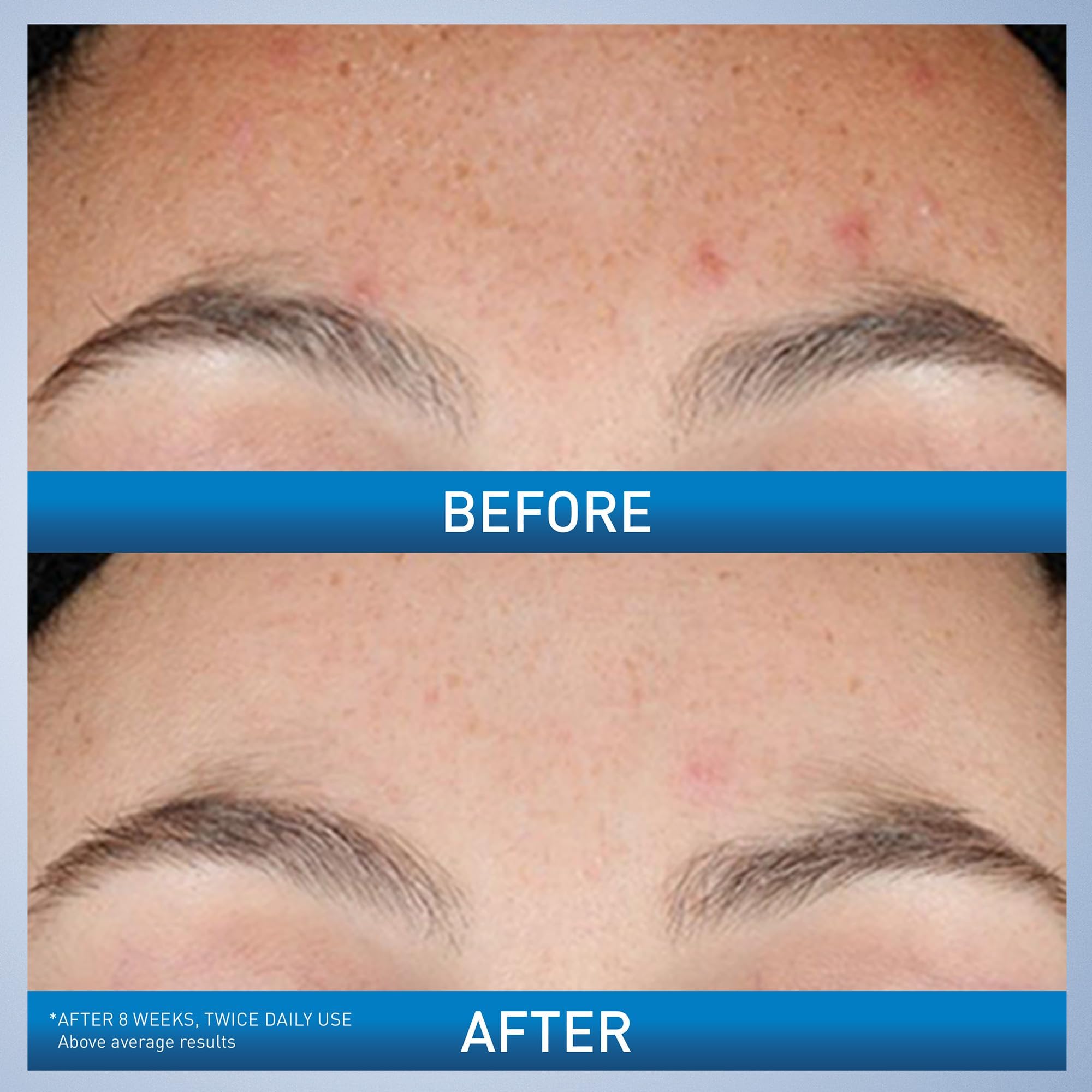 CeraVe Resurfacing Retinol Serum For Post Acne Marks, Formulated With Licorice Root Extract & Niacinamide, Brightening Serum & Pore Minimizer For Face, Post Acne Skin Barrier Repair, Non-Comedogenic - Image 3